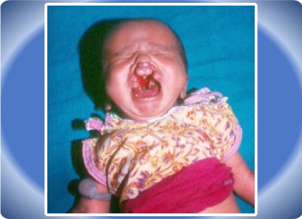 CLEFT LIP